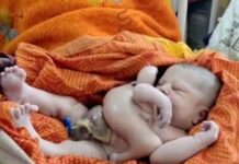 Вважають втіленням бога Вішну: в Індії народилася дитина з чотирма руками та ногами